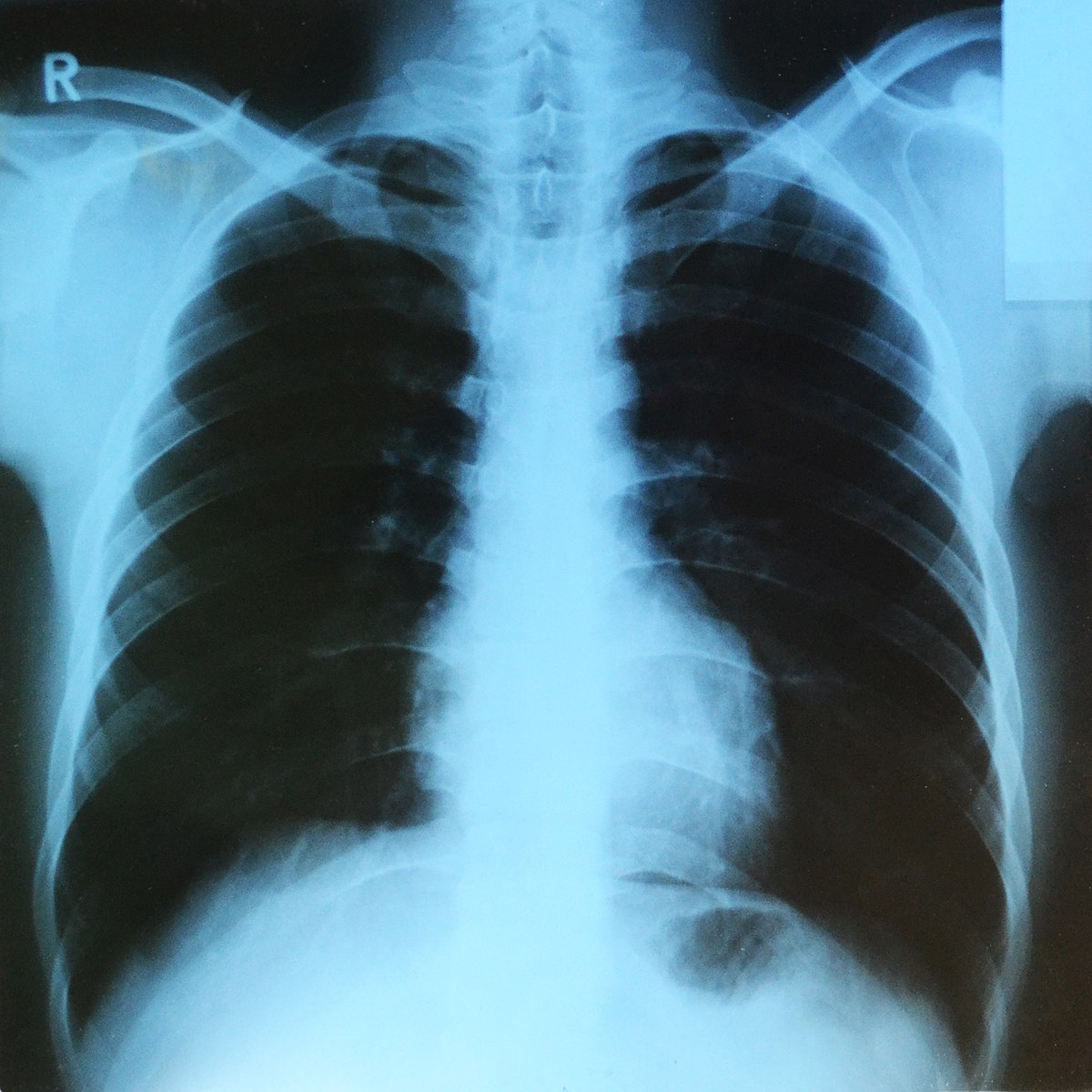 Lung X-Ray