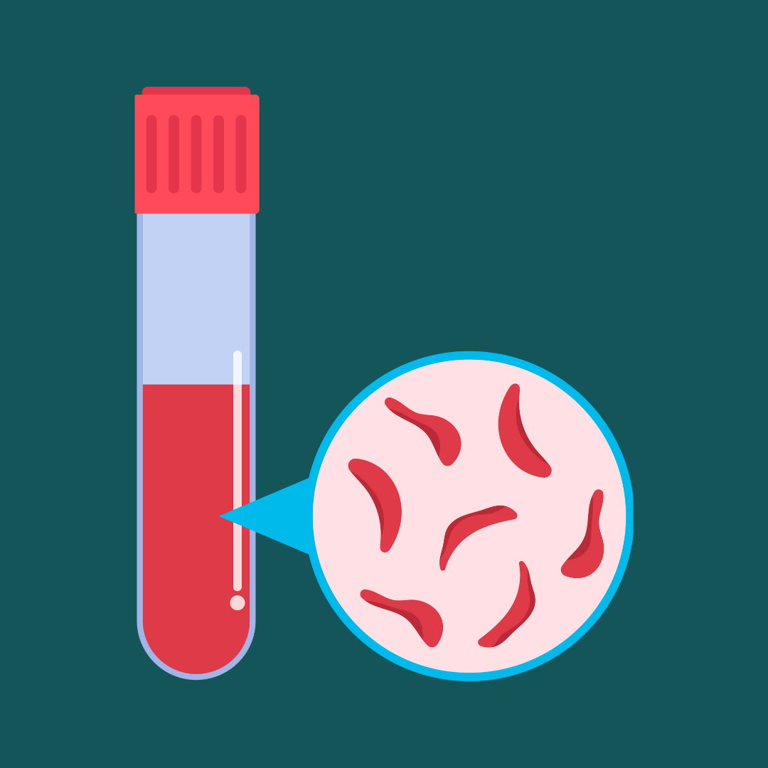 sickle cells in a blood sample