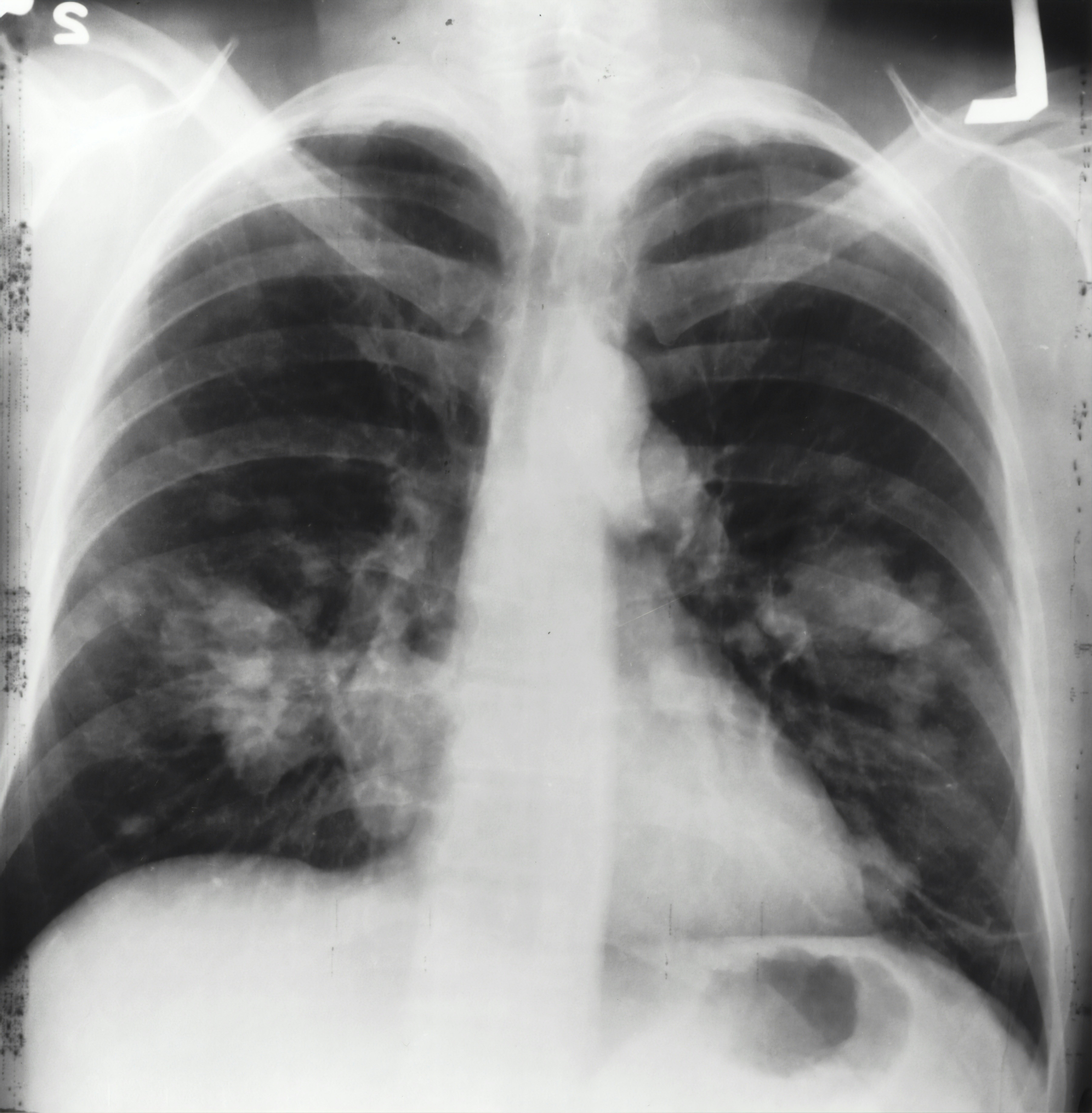 X-ray image of a pair of lungs