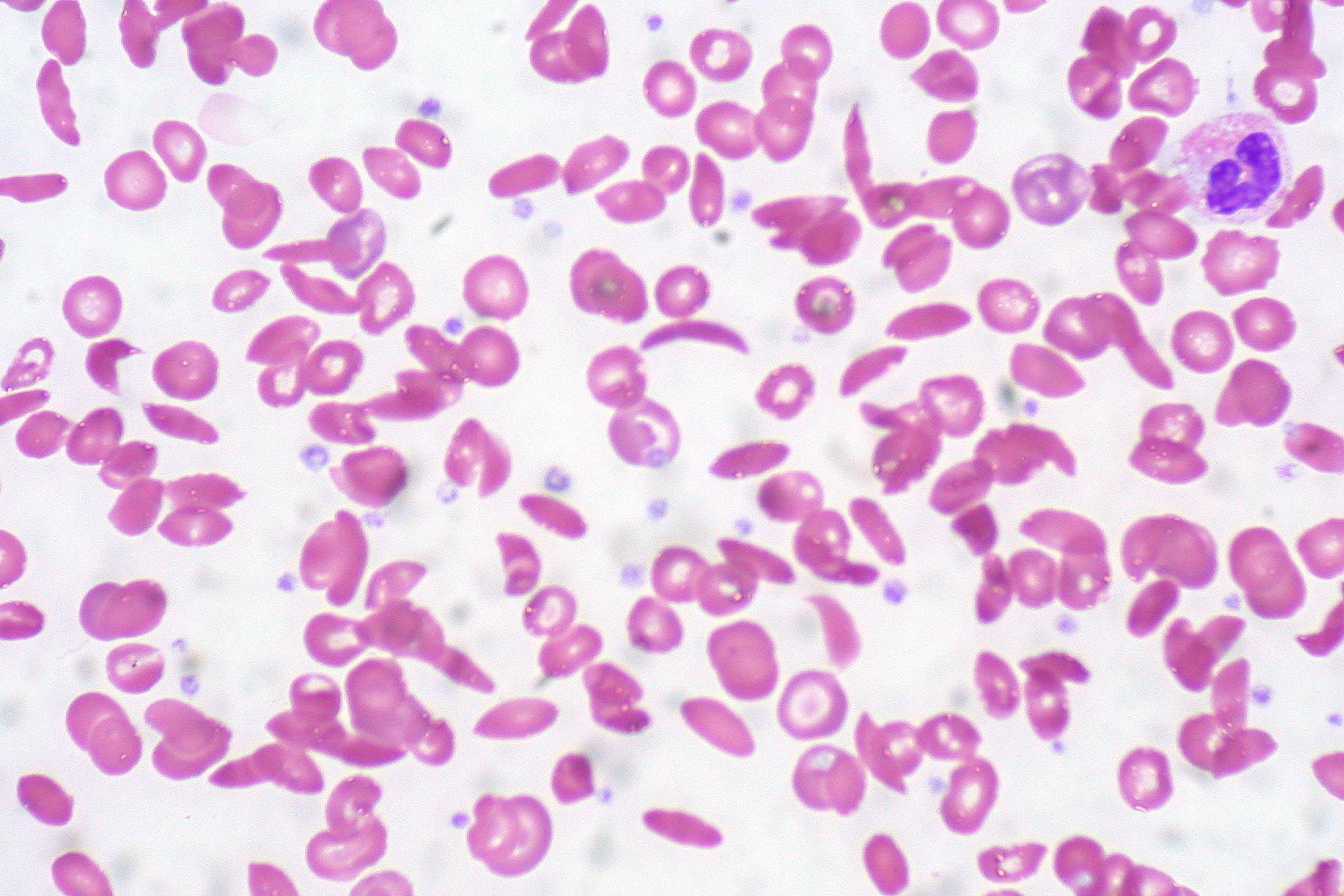 Purple-colored sickle cells over a white background
