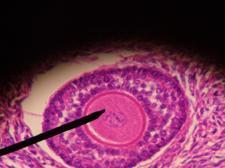 A human ovary is punctured by an operator who inserts a needle through the vaginal wall and into an ovarian follicle to remove an oocyte for storage.