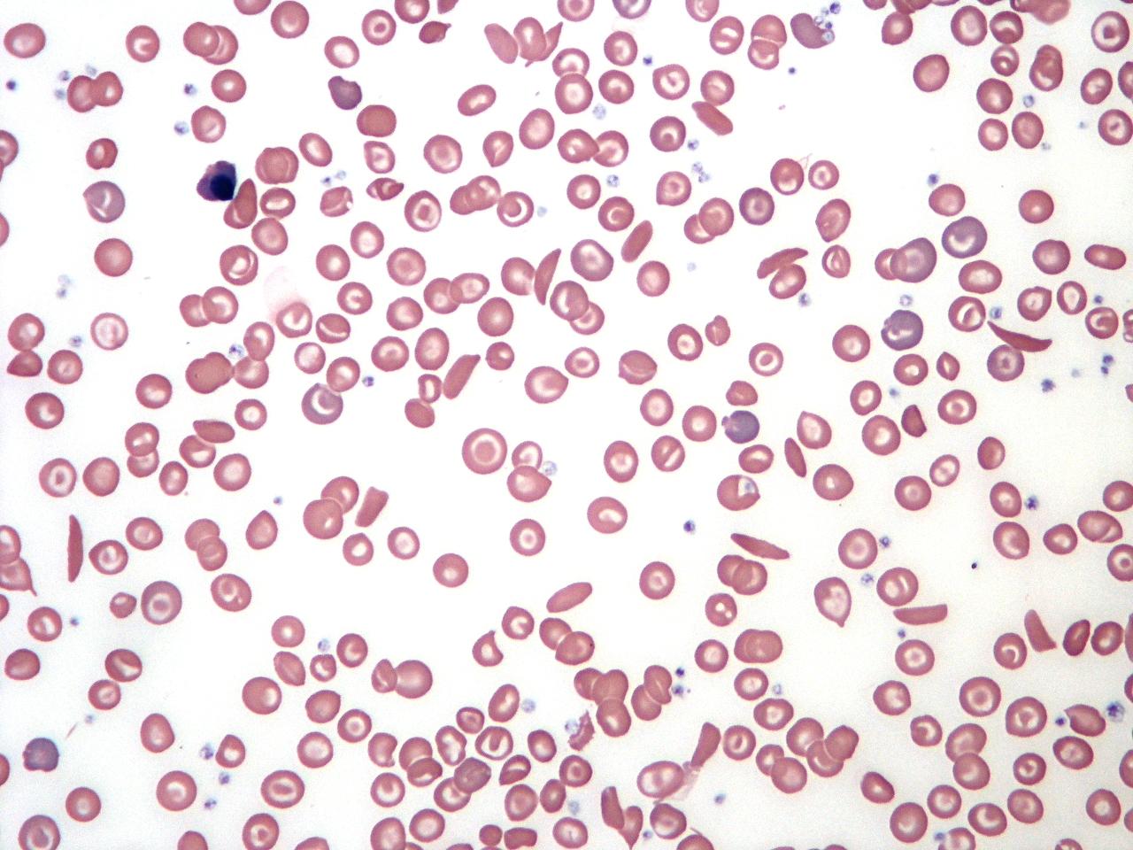 sickle cell blood smear