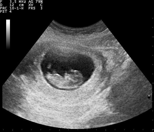 Black and white ultrasound image with a small fetus in the middle 